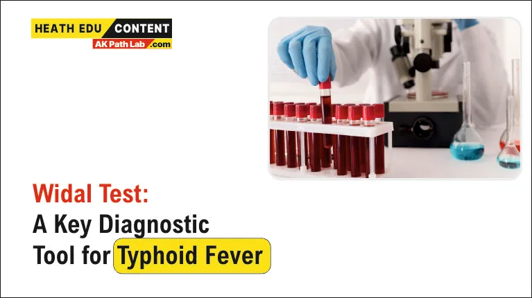 Widal Test: A Key Diagnostic Tool for Typhoid Fever